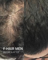 Fusion Meso F-Hair Microneedling Treatment
